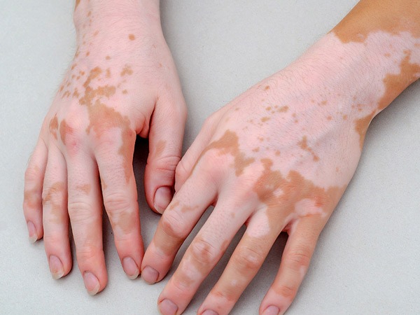 手脚白癜风频发的原因有哪些