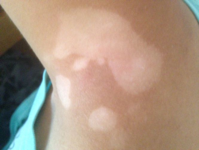 预防青少年白癜风复发的方法有哪些