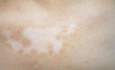 白癜风用药要避免哪些误区