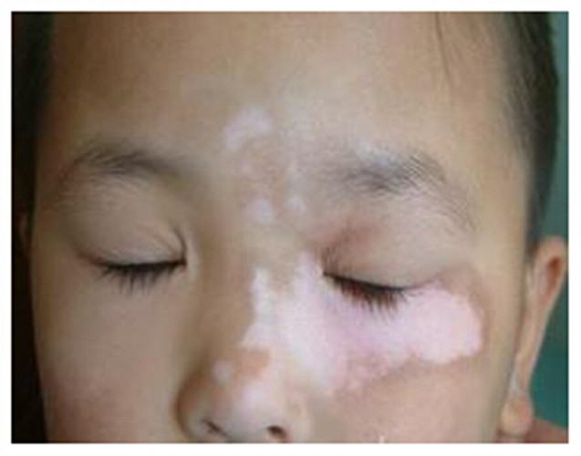 白癜风患者应该怎样保持良好的心态