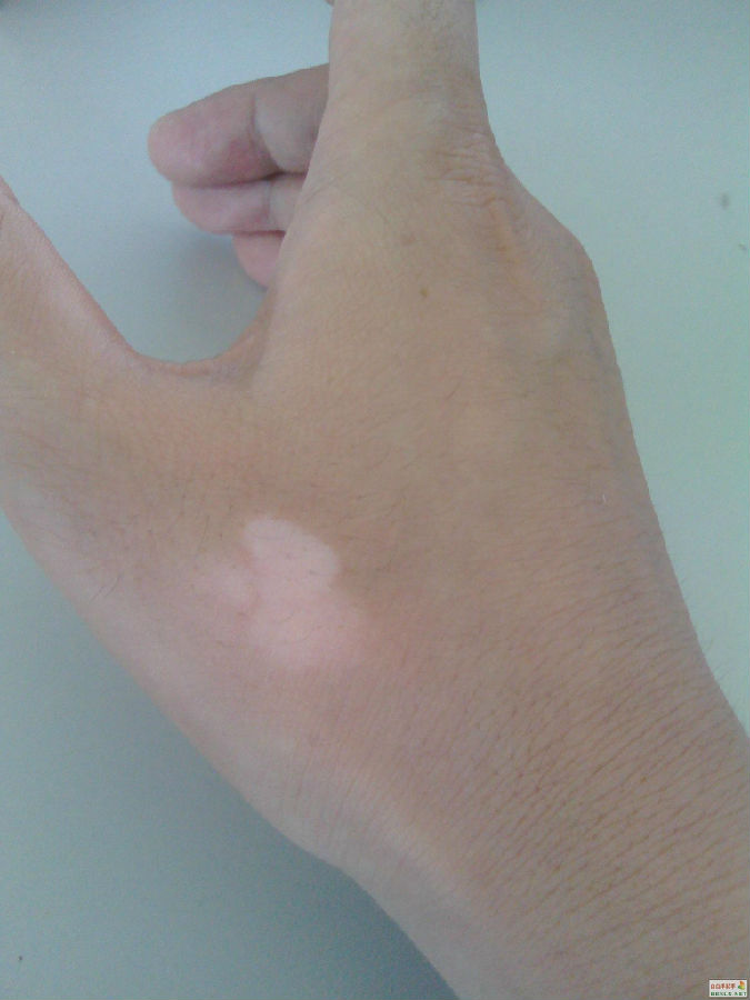 白癜风患者需要注意什么问题