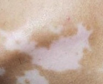 背部白癜风治疗要注意什么