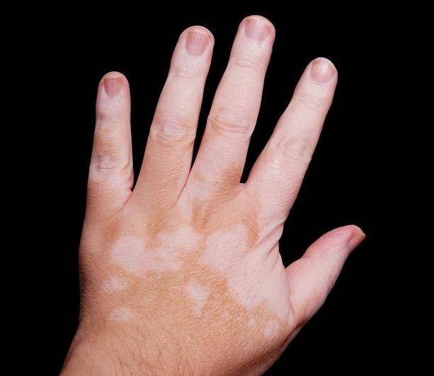 白癜风患者能吃什么鱼