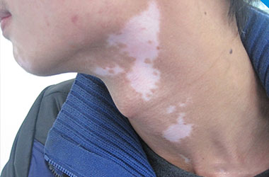 诱发局限型白癜风的原因是什么