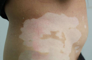 白癜风在治疗期间如何护理