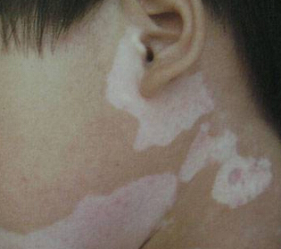 脸上出现白斑的原因是什么