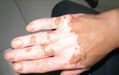 肢端肥大症白癜风该如何治疗呢